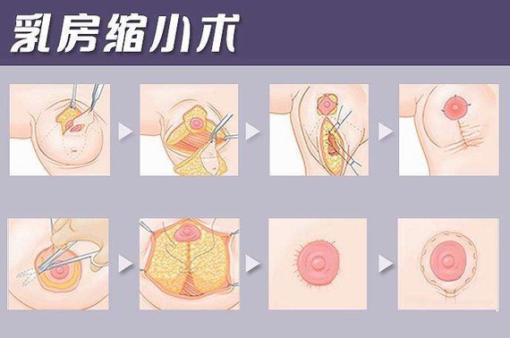 乳房过大可以做手术去除吗,乳房太大做缩乳手术有危险吗