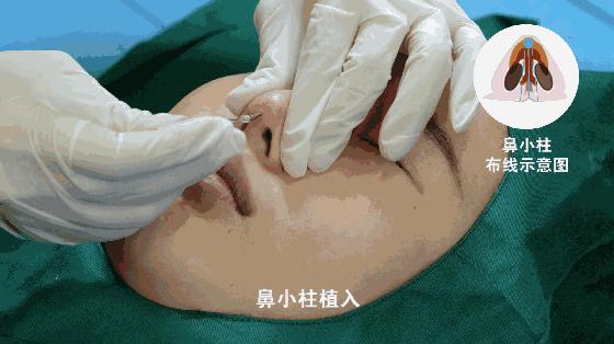 线雕隆鼻做出来不平,线雕隆鼻为什么没什么改变