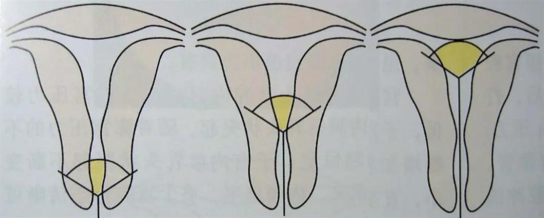 多次宫腔操作是什么意思,每次宫腔灌注要间隔多久