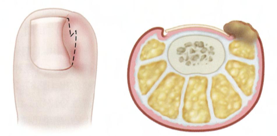 怎么用棉花治疗甲沟炎,严重甲沟炎用棉花塞有用吗