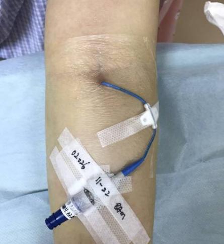 picc穿刺点有少量出血应如何护理,化疗肿瘤患者生命线