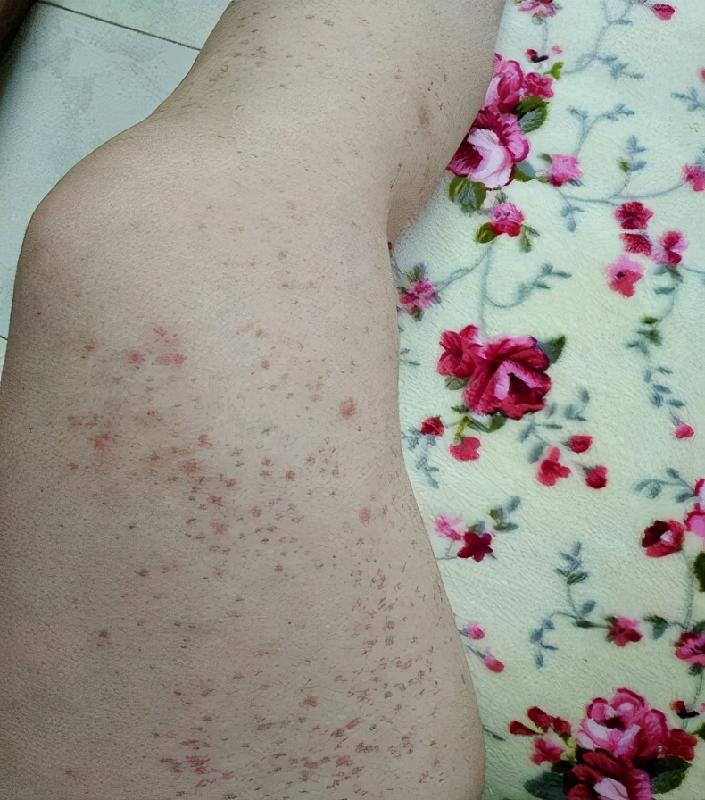 身上的小红点是不是代表得了肝病,身上有红点是肝病的前兆吗