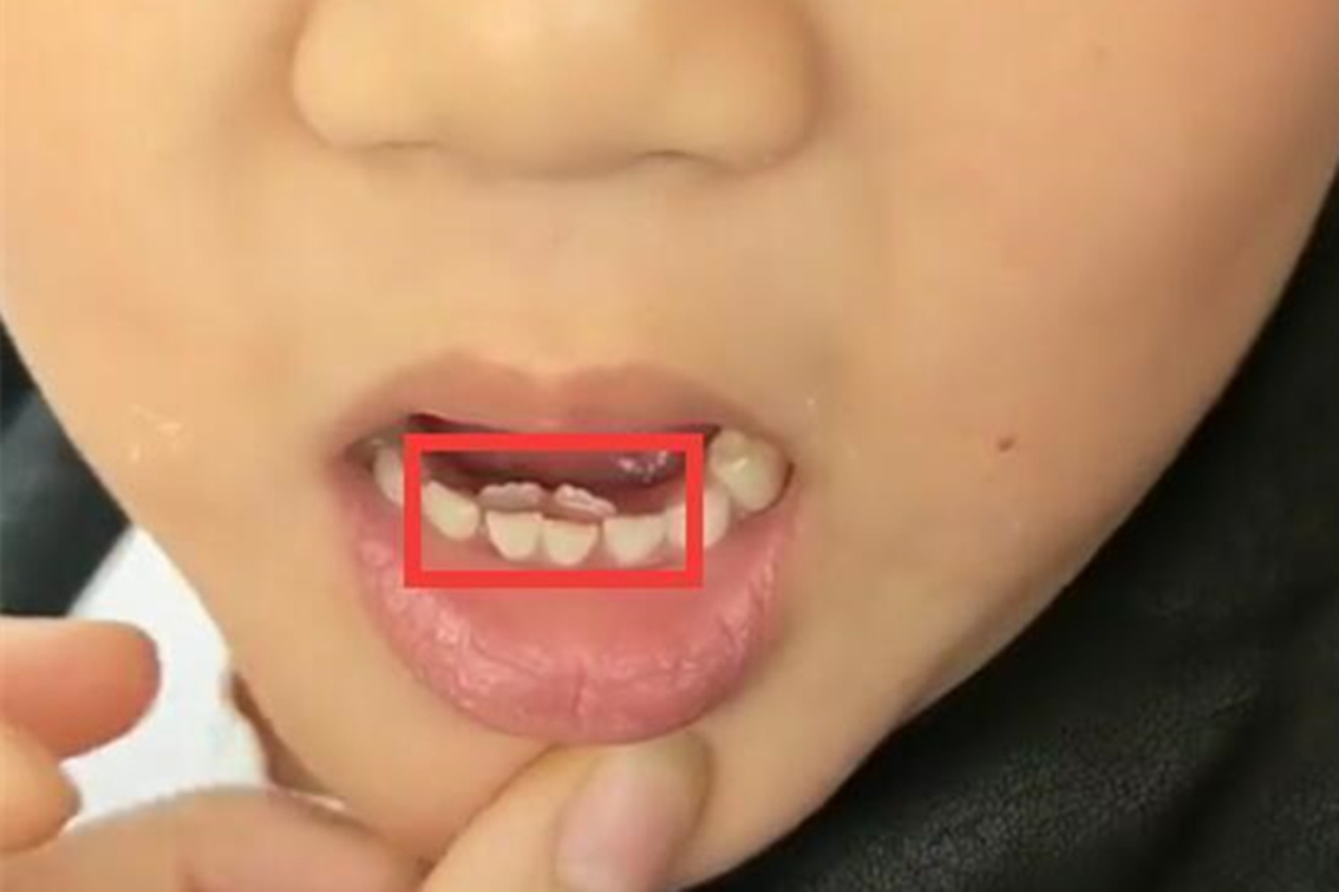 孩子长出双排牙只因父母爱太多,7岁孩子长了双排牙怎么处理