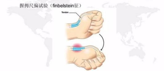 腱鞘炎3次治愈,腱鞘炎在三甲医院挂什么科