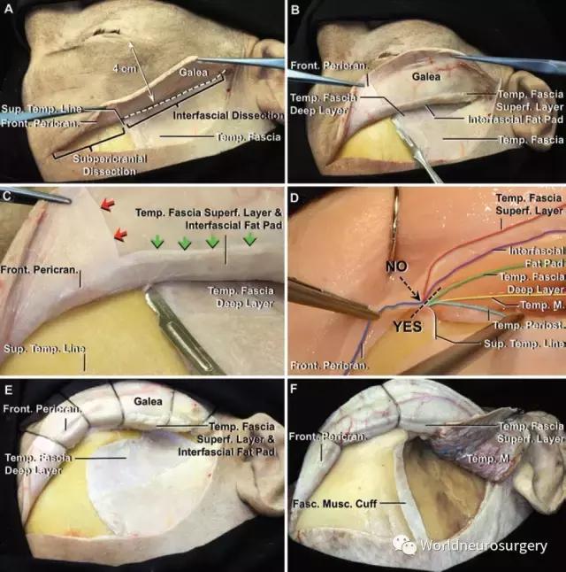 翼点入路技巧图解,翼点入路的开颅要点