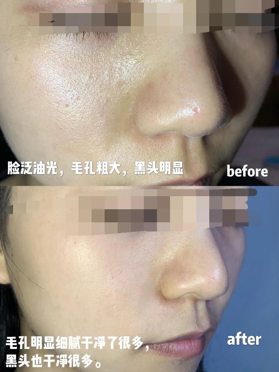 好用的去除黑头小妙招,去除黑头小窍门一招解决