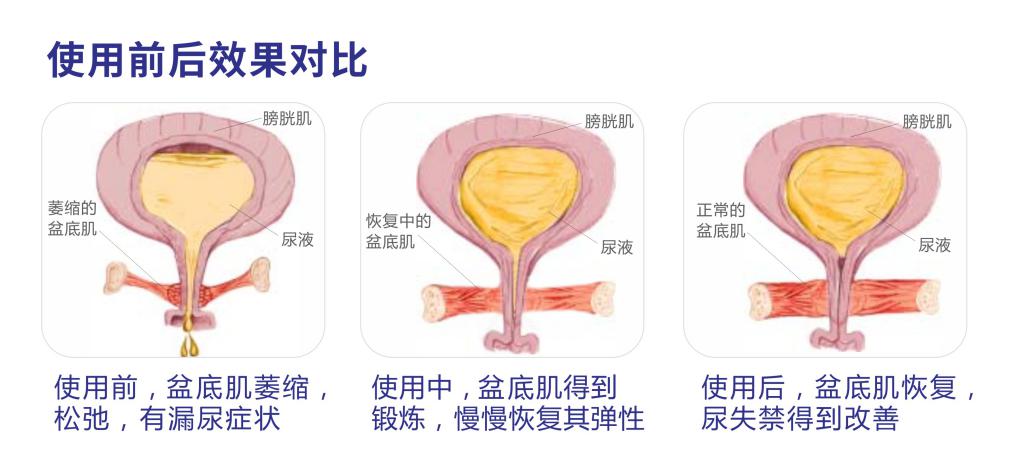 生物反馈电刺激在产后盆底肌康复的应用及效果研究