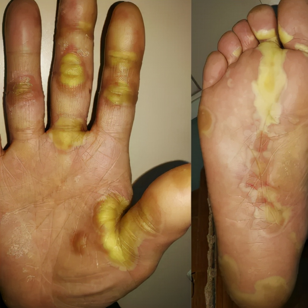 靶向药皮肤副作用怎么缓解,靶向药物副作用引起皮肤溃烂图片