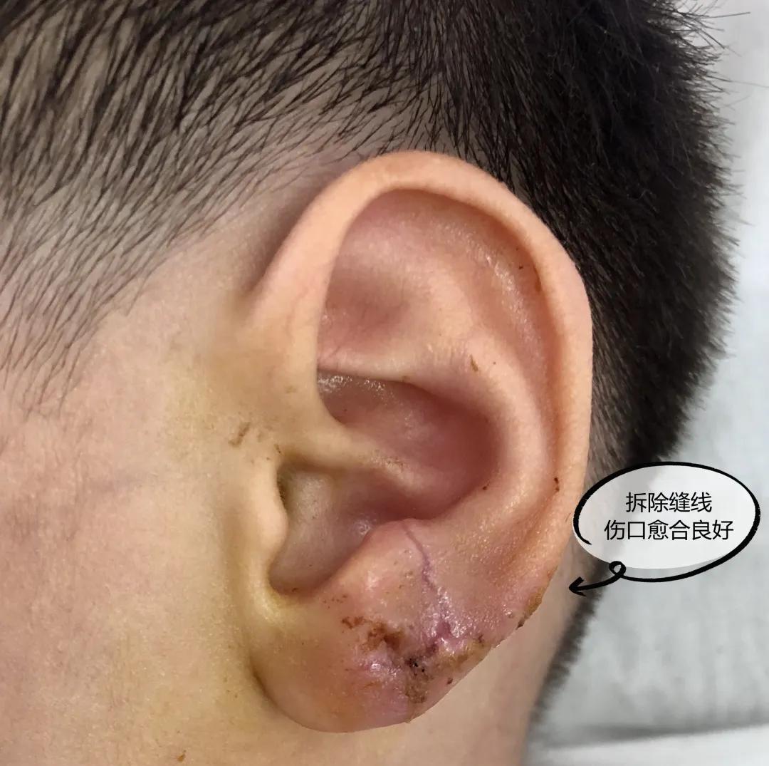 小孩耳垂根部裂开一道口子,孩子耳垂裂开了一条缝