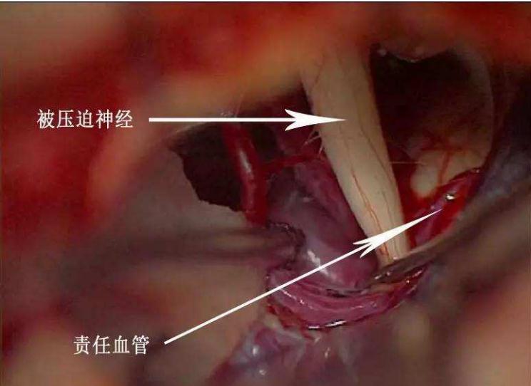 张医生治病救人后续,左眼皮一直跳咋回事好像痉挛