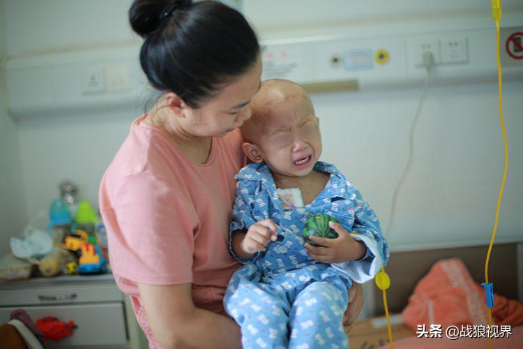 小孩摔一跤后引起眼袋淤青,2岁多男宝眼袋浮肿有点发紫