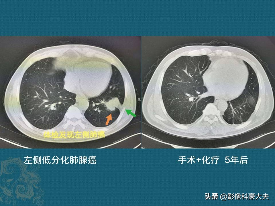 这5种癌一发现就是晚期,第一例癌症患者治愈