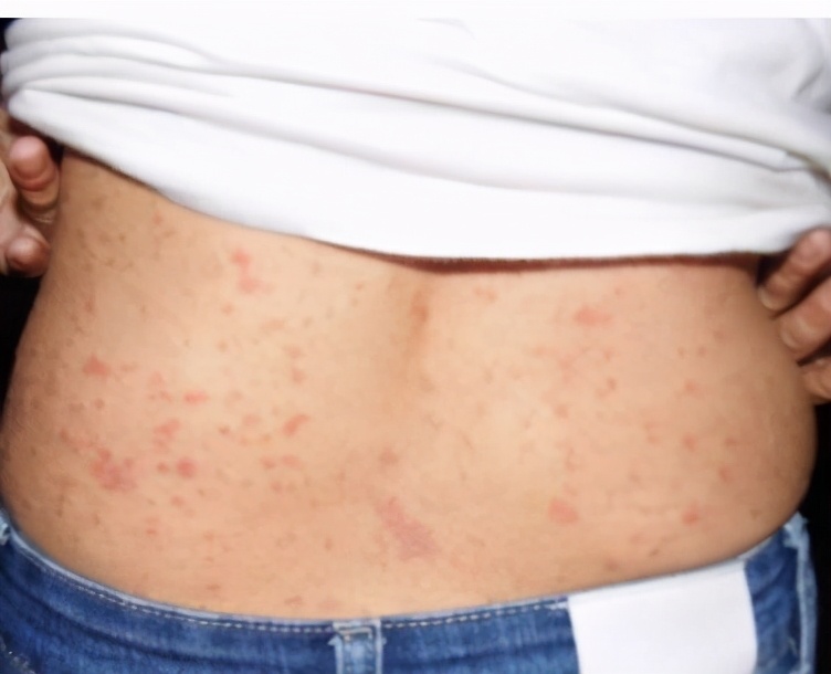 门诊案例｜人的好多病是吃出来的，治皮肤病先调理脾胃