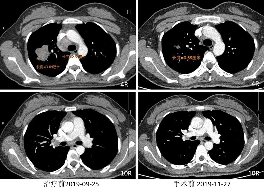 PD-1新辅助治疗初探，典型案例汇总一览