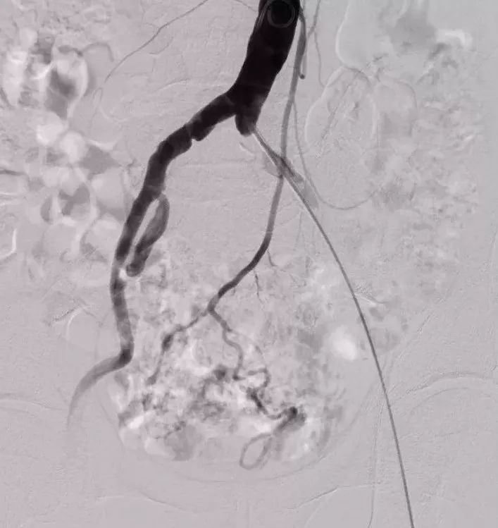 经常做介入对医生有影响吗,做了一次介入治疗不做了会怎样