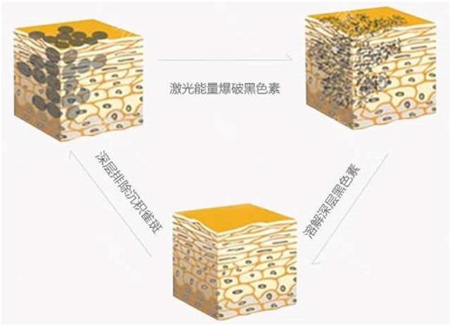 激光祛斑十五年以后再点斑可以吗,脸上长斑真的可以治好吗
