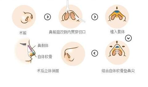 硅胶耳软骨隆鼻会透光吗,硅胶隆鼻透光怎么解决