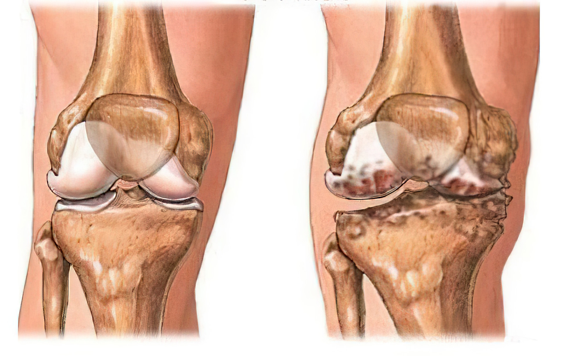 走路膝关节打软是什么病,走路打软腿是不是血管的问题
