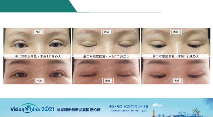 潘贰眼博士双眼皮原理,潘贰眼部整形案例