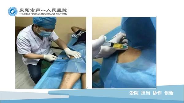 臭氧玻璃酸钠治疗膝关节炎怎么样,膝关节滑膜炎臭氧