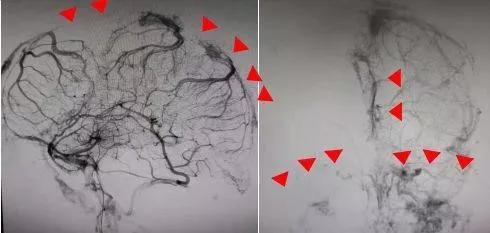 熬夜加班后脑袋疼,26岁小伙熬夜加班后头晕