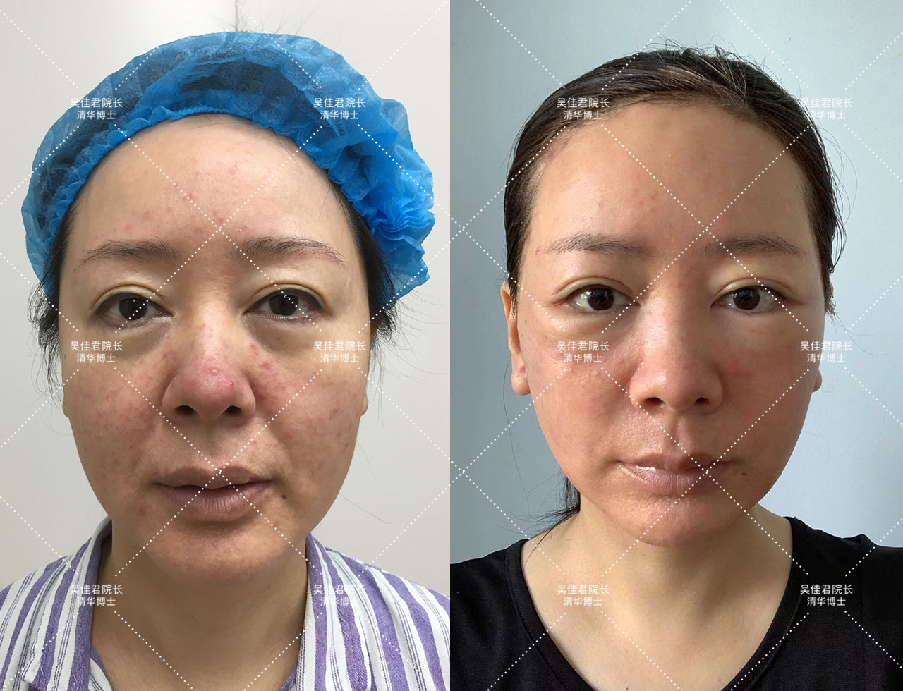 大拉皮术后50天真实感受,拉皮手术5年之后的变化