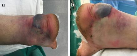 高处跌落脊椎骨折需要手术吗,高处坠落导致骨盆骨折怎样治疗
