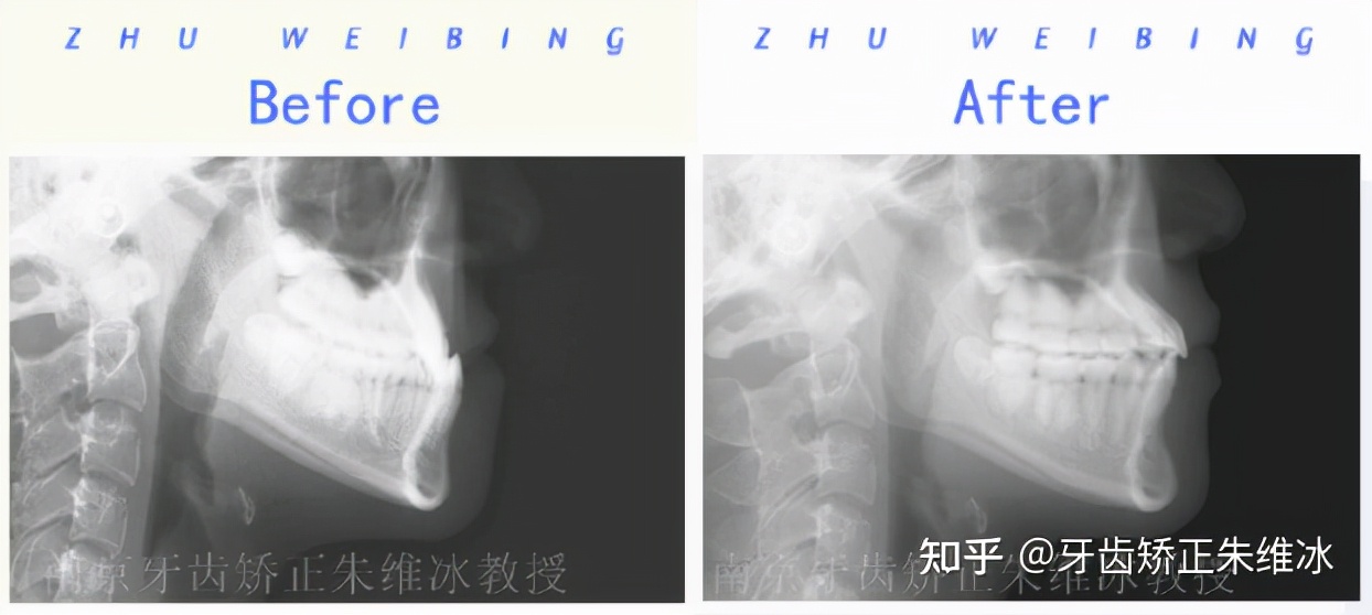 南京透明式牙齿矫正器地包天,18岁功能性地包天能改善面型吗