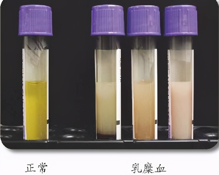 50岁的阿姨抽出“猪油血”，医生提醒：春节饮食要注意