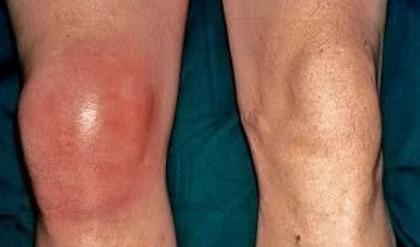 膝盖有滑膜炎,还能治愈吗?该怎么办?不想手术,3个要点需牢记