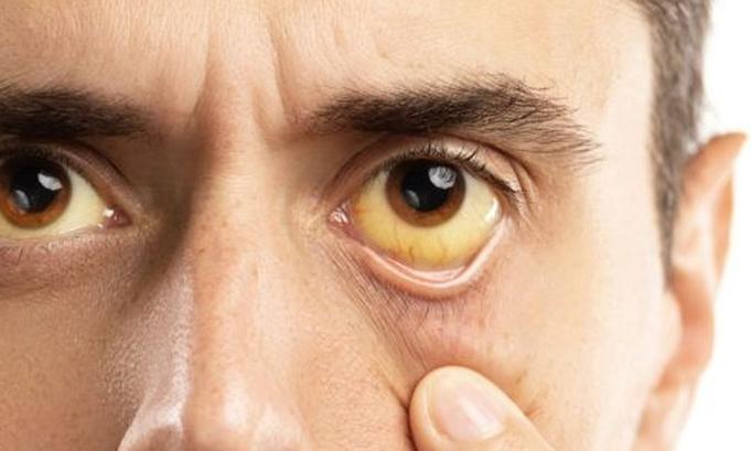 肝不好出现2痒3黑,肝不好的人会出现一痒二痛三黄