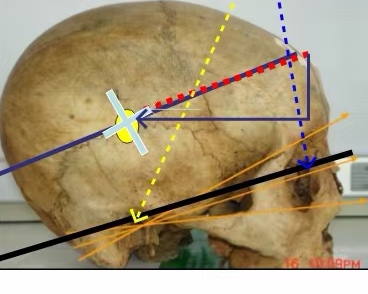 硬脑膜外血肿引流,高压氧治疗颅内出血