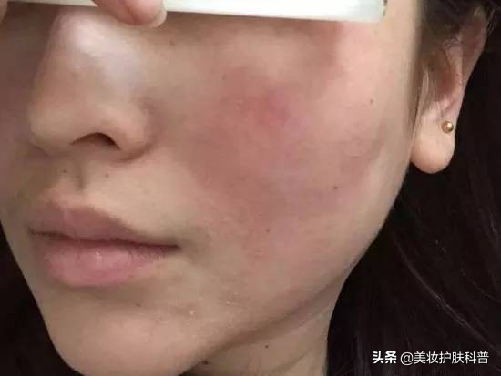 春暖花开过敏症状,春暖花开时预防过敏方法