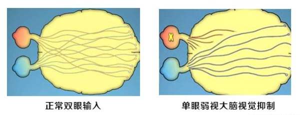 12岁先天弱视治疗需多少钱,孩子12岁弱视0.4怎么恢复正常