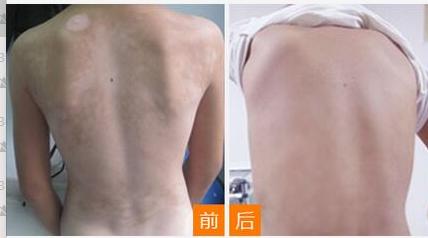 白癜风uvb光疗效果,uvb光疗仪治疗白癜风对皮肤的危害