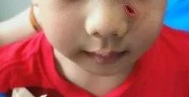 一男孩被公鸡抓伤脸部长出鸡爪,小孩被公鸡抓伤了会不会留疤