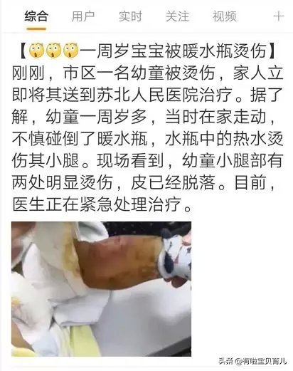 宝宝被烫伤第十三天,宝宝被开水烫伤要打针吗