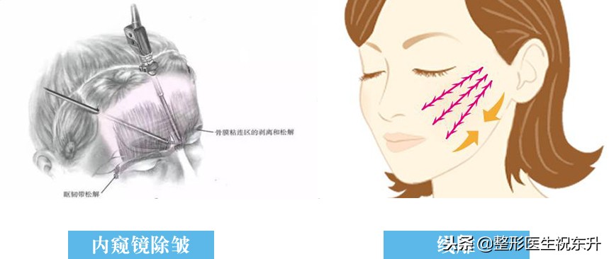 线雕除皱什么意思,线雕除皱可以同时做吗