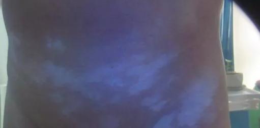 为什么身上出现很多白斑怎么治疗,白斑经过治疗后边缘发黑是为什么