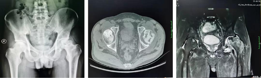 股骨头机器人手术微创,骨科机器人股骨颈手术