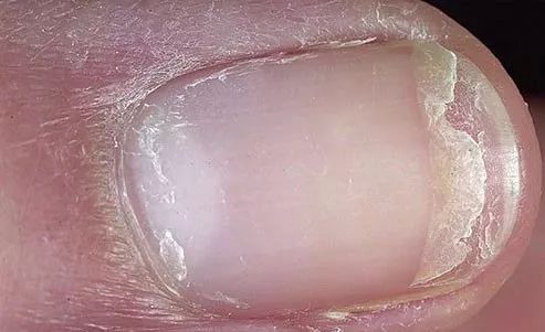 娃指甲上有白点是怎么回事,孩子指甲横纹有白点