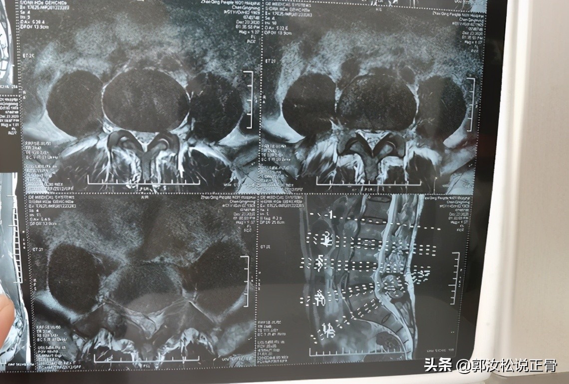 腰椎滑脱病例分析,腰椎滑脱症及手术方法的进展