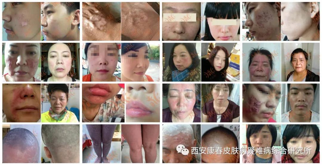 西安康春皮肤病研究所产品,西安康春皮肤病研究所官网