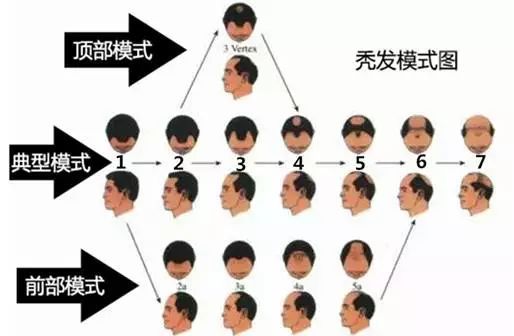 远离脱发这4个问题你需要知道,脱发问题越来越常见了