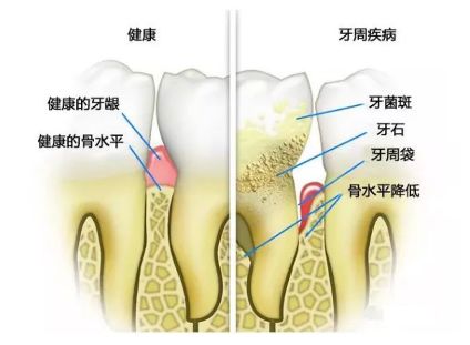 疫情防控期间如何正确预防及应对口腔问题