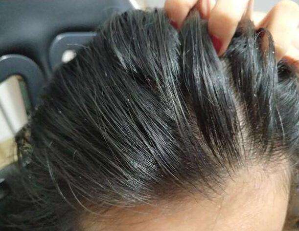 头发出油干燥脱发是什么原因,夏季头发出油严重