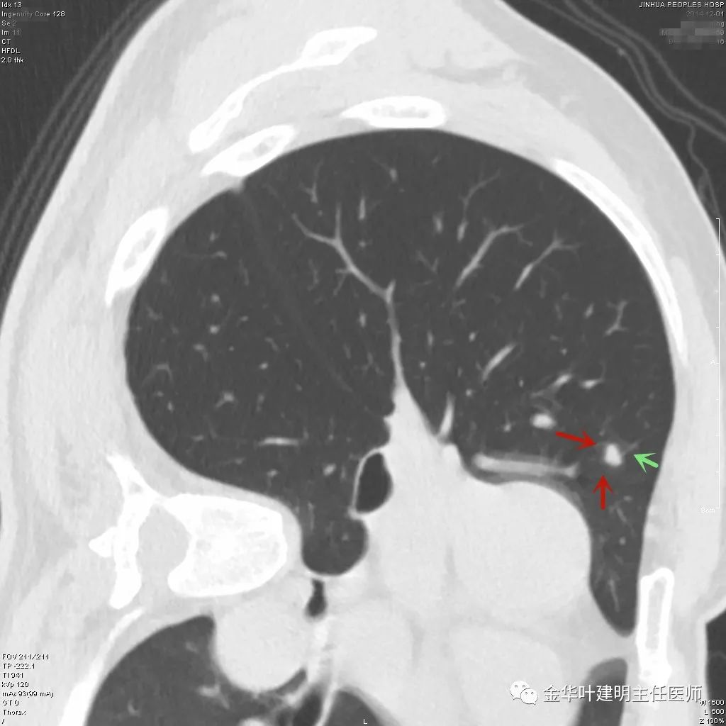 叶建明谈实性结节,叶建明肺实性良性结节会变癌症吗