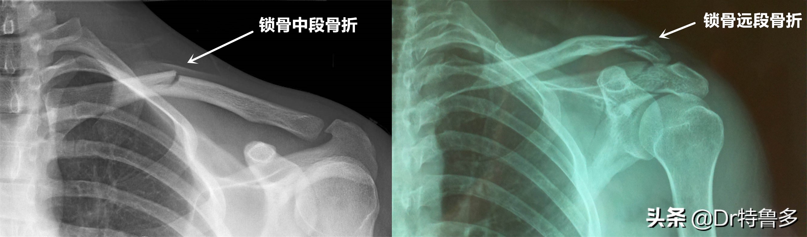 骨折能避开灾祸是迷信么,骨折恢复后腿有坑是怎么回事