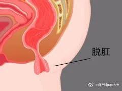 鲨鱼脱肛是什么,鲨鱼脱肛怎么治疗最好