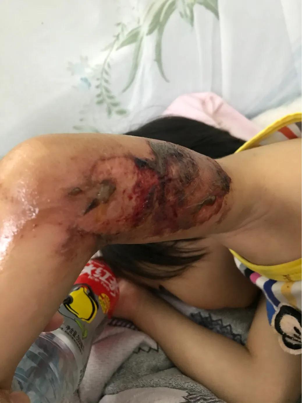 当女儿被严重烫伤疼痛难忍,幼儿园女孩被烫伤治疗过程